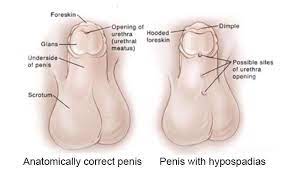 Penis with Hypospadias