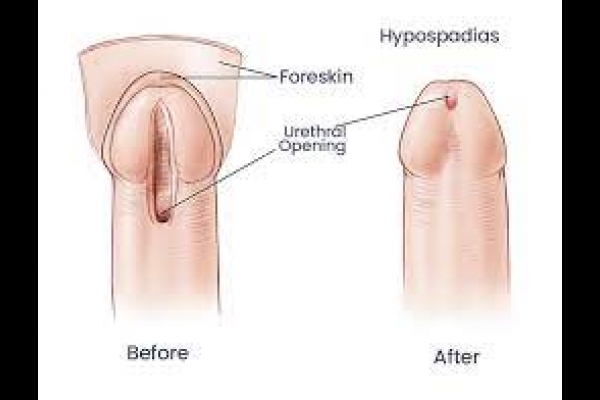 After Hypospadias Surgery