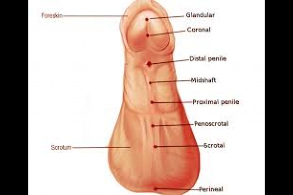 Hypospadias penis