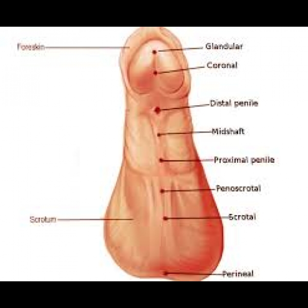 Hypospadias penis