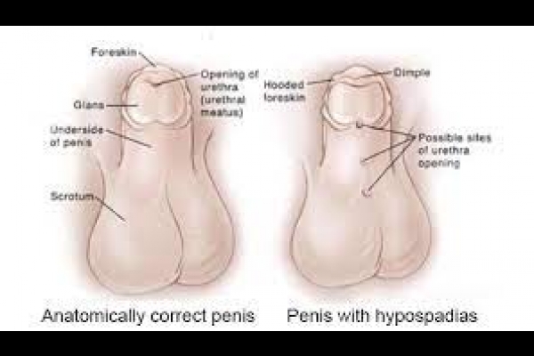 Penis with Hypospadias