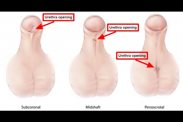 Type of Hypospadias